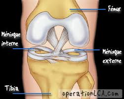 As previously stated in other answers i would advise you get this repaired, it will not mend itself and there is no cure, mine was painful enough that it began to affect walking and eventually was painful all the time, especially in winter (reason. Menisque