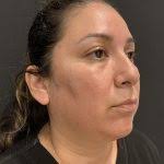 Submental Liposuction Before and After Photos Austin, TX