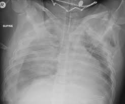 Pneumothorax occurring in healthy people. Hemothorax Radiology Reference Article Radiopaedia Org