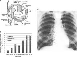 We hope this picture anatomy of the rib cage diagram can help you study and research. A Schematic Diagram Of The Rib Cage And Its Corresponding Mechanisms Download Scientific Diagram