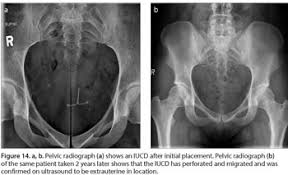 Laparoscopic understanding of pelvic anatomy and its application in benign and radical pelvic surgery. Abdominal And Pelvic Radiographs Of Medical Devices And Materialspart 2 Neurologic And Genitourinary Devices And Materials Document Gale Onefile Health And Medicine