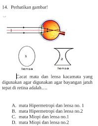Jenis cacat mata dan kacamata apakah yang dapat menolong penderita cacat mata tersebut. Cacat Mata Dan Lensa Kacamata Yang Digunakan Agar Digunakan Agar Bayangan Jatuh Tepat Di Retina Brainly Co Id