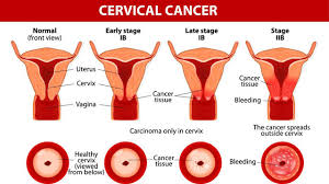 Early on, typically no symptoms are seen. Cervical Cancer Screening Symptoms Treatment Mount Elizabeth Hospitals