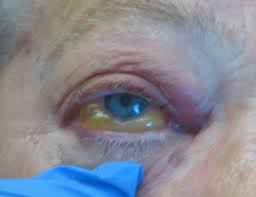Mucormycosis is a rare, severe infection with fungi of the order mucorales. Invasive Fungal Orbitorhinocerebral Mucormycosis Eyerounds Org Ophthalmology The University Of Iowa
