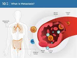While some people with invasive cancer may consider cis or stage 0 cancer as less concerning, the uncertainty associated with this finding, and wondering about whether and how to. What Is Cancer National Cancer Institute
