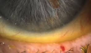 Image result for lesion sclera
