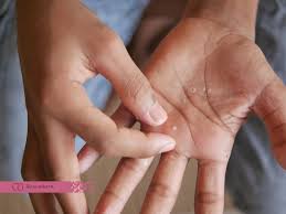 Image result for dyshidrosis