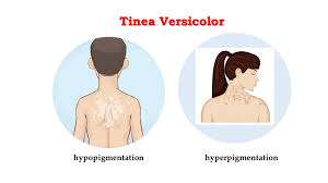 Topical antifungal medications are the treatment of choice for tinea versicolor. Tinea Versicolor Creative Biolabs