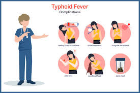 Image result for Typhoid Fever