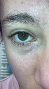 The Eyes Have It For High Blood Pressure Clues | American Heart Association