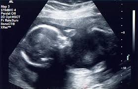 Je suis actuellement enceinte de 5 mois et lors de ma dernière echo (environ 10 jours) le médecin m'a assuré à 100prct que j'attends une fille… Le Developpement Et La Reproduction Des Etres Humains Fiche De Cours Svt Schoolmouv