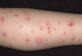 Picture Of Flea Bites