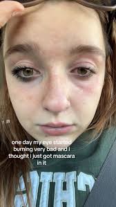 What Happened to Burns Eye