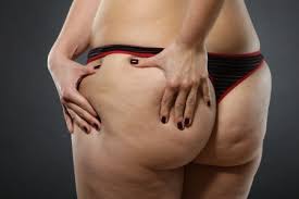 Die entstauung des gewebes durch bestimmmte physiotherapeutische techniken. Cellulite Bzw Orangenhaut Bekampfen Dr Boorboor