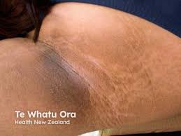 Image result for Ozoroa nigricans