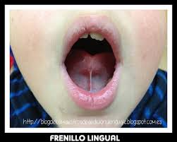 Frenillo Lingual Y Rotacismo Maestros De Audicion Y Lenguaje