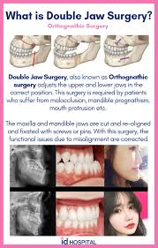 What Is Orthognathic Double Jaw Surgery
