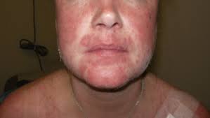 Symptoms include inflammation, swelling, and damage to the joints, skin, kidneys, blood, heart, and lungs. Skin Disease In Cutaneous Lupus Erythematosus Sciencedirect