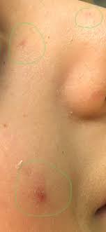 Tinea versicolor is a fungal infection that affects the skin. Ubeozpnng1 M7m