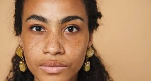 Image result for Hyperpigmentation