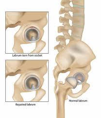 Image result for Hip Labral Tear