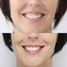 How to solve a gummy smile. Gummy Smile Treatments Melbourne Smile Solutions