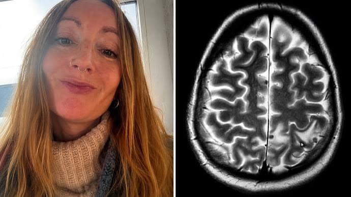 UK News: Got 38 parasites in brain after India visit, says British woman. 3 facts and a question - India Today