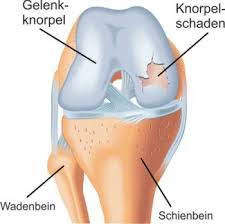 Knorpelschaden Chondropathie Im Knie Diagnose Und Therapie Priv Doz Ddr Christian Albrecht Knie Und Knorpelspezialist