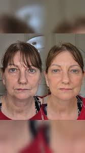 "It's my birthday, so I wanted to treat myself to feel like myself again' ,  Realistic feminine natural results with 5ml , Interested in booking for a  filler packages? , DM for inquiries 🤍, ...