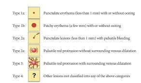 Image result for Small Intestinal Bleeding