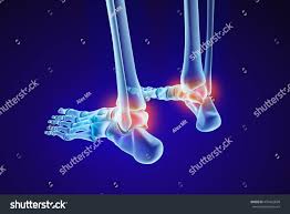 It articulates with the talus and the three cuneiform bones. Skeletal Foot Injuryd Talus Bone Xray View Medically Accurate 3d Illustration Ad Ad Talus Bone Injuryd In 2020 Logo Design Trends Logo Design 3d Illustration