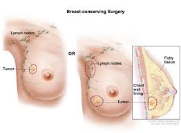Approximately 30 percent of cancers in women are breast cancers. Breast Cancer Treatment During Pregnancy Pdq Treatment Patient Information Nci Michigan Medicine