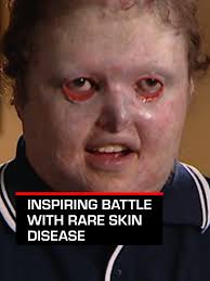 Dean Clifford: Living with Epidermolysis Bullosa