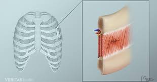 Causes Of Intercostal Muscle Strain