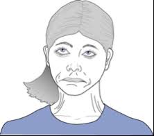 Image result for Extrapyramidal Side Effect