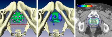 prostate cancer develops when the rates of cell division exceed those of cell death, leading to uncontrolled tumor growth. Thermotherapy Of Prostate Cancer Using Magnetic Nanoparticles Feasibility Imaging And Three Dimensional Temperature Distribution European Urology