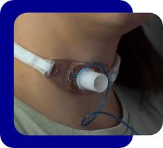 Image result for Tracheostomy