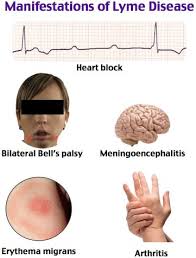 Rosh Review Lyme Disease Disease Critical Care Nursing
