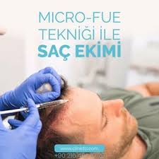 Micro Fue Teknigi Ile Kaybettiginiz Saclariniza Yeniden Kavusabilirsiniz 90551 387 7882 90546 916 8576 Hair Hairtransplantation Hairl Sac Instagram Roma