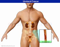 There were 1,099 cases of kidney and renal pelvis cancer diagnosed and 241 deaths from kidney and renal pelvis cancer in 2016. Ureteral Cancer Or Ureter Cancer Or Renal Pelvis Cancer Causes Symptoms Treatment