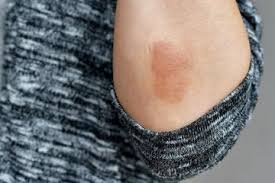 Perenang gatal atau dermatitis serkaria juga menjadi penyebab bintik merah pada kulit. Disebut Gejala Covid 19 Ini Penjelasan Dokter Kulit Soal Bintik Merah Corona Semua Halaman Nakita