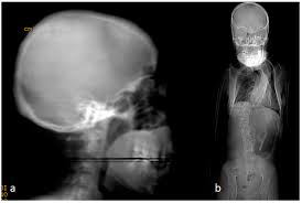 Image result for Craniotabes