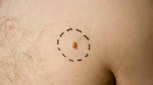 The signs and symptoms of skin cancer an include new skin lesions, a change in the shape, color, texture, or elevation of an existing mole any new spots that appear on the skin could potentially be a skin cancer, considering that one in five people will develop at least one skin cancer in their lifetime. Pictures Of Melanoma Skin Changes To Look For And More