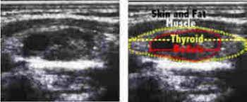 Training in musculoskeletal ultrasound does not lend itself easily to 'levels' of training and instead a 'modular' approach is recommended (appendix 11). Thyroid Nodule Ultrasound What Is It What Does It Tell Me Quick Painless Inexpensive And Accurate