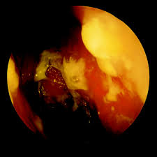 But according to medlineplus, symptoms can include a runny or stuffy nose, loss of smell or. Nasal Manifestations Of Rheumatic Diseases Annals Of The Rheumatic Diseases