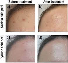 Mar 12, 2015 · it is usually recommended that azelaic acid is used for at least 4 weeks but it could take several weeks before any obvious improvement can be seen. A Comparison Of The Effectiveness Of Azelaic And Pyruvic Acid Peels In The Treatment Of Female Adult Acne A Randomized Controlled Trial Scientific Reports