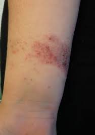 Image result for Rhus Dermatitis