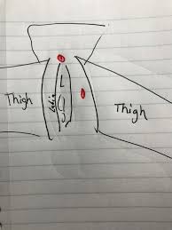 This area should be qualified and validated before starting its use. Female Groin Area Hidradenitis