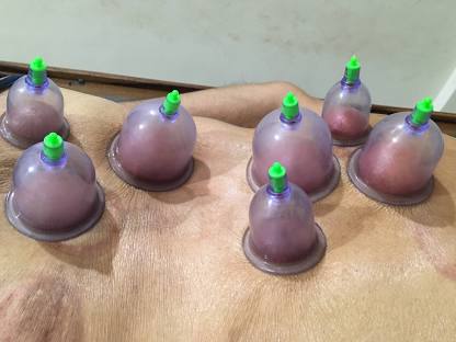 Cupping Therapy