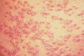 Vitamin d and its role in psoriasis: 10 Cara Usaha Alternatif Merawat Psoriasis Di Rumah